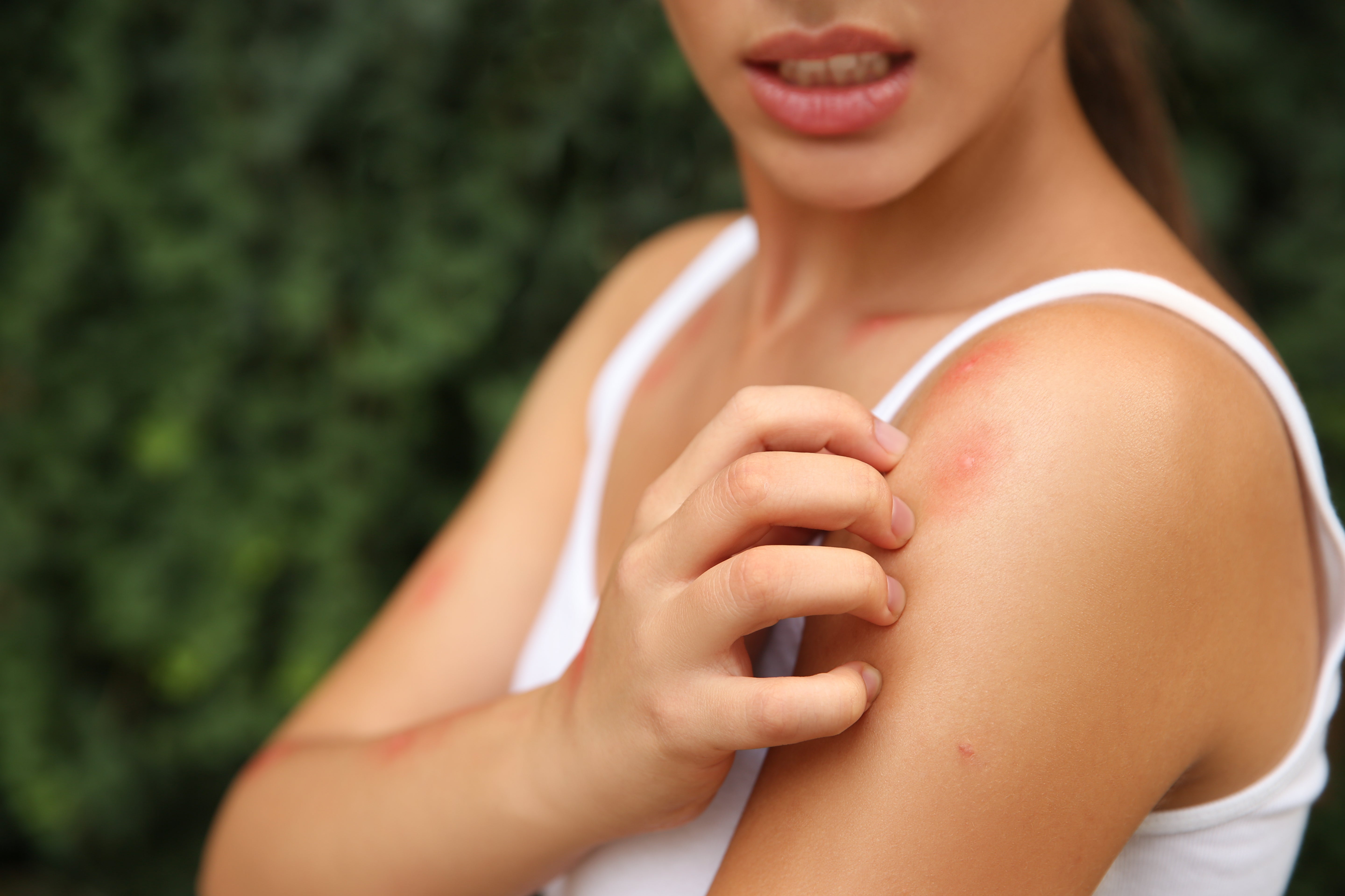 A close-up lifestyle shot of a woman scratching her shoulder with her hand because of mosquito bites, wearing a white tank top against a blurred green outdoor background.